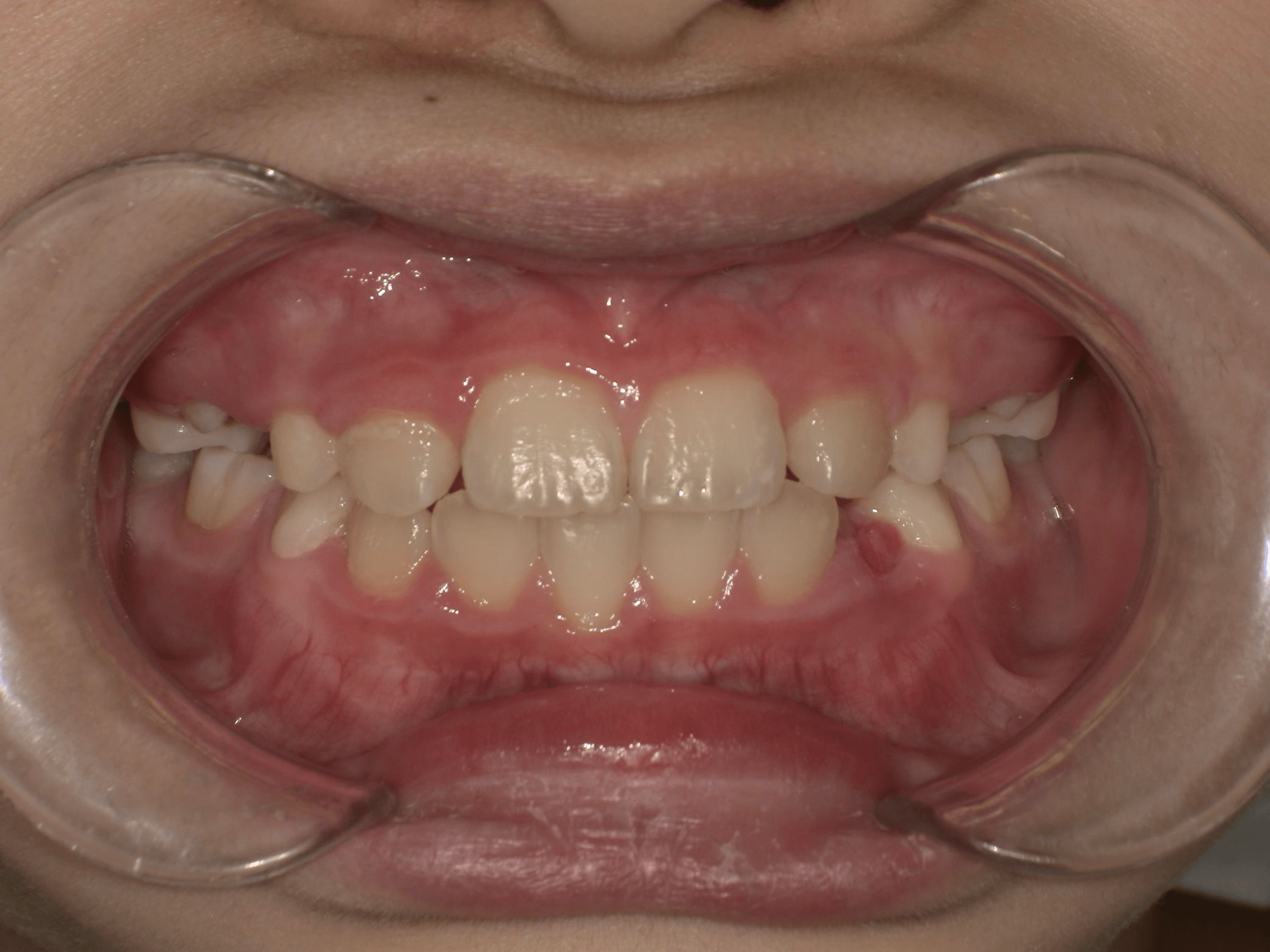 Pediatric After