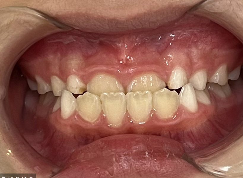 Pediatric Before