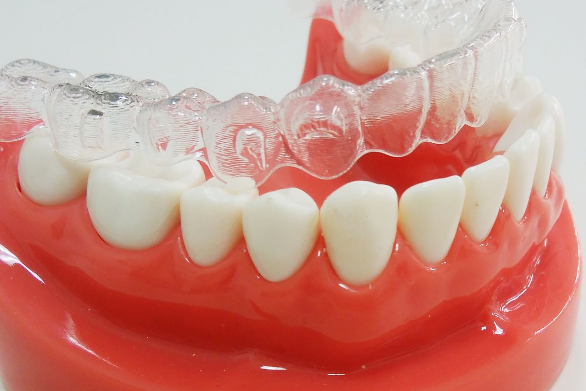 インビザライン部分矯正：前歯の歯並びを美しくするためのスマートな選択