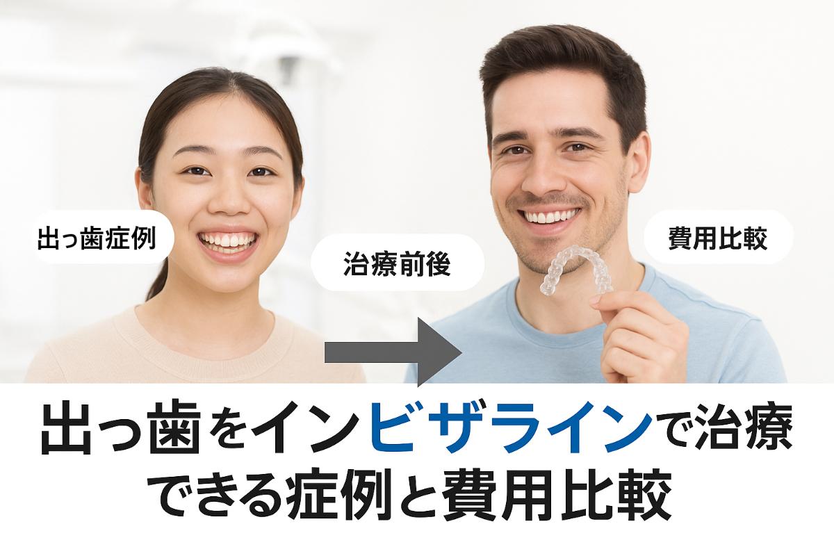 出っ歯をインビザラインで治療できる症例と費用比較｜最新技術や期間・横顔変化も解説